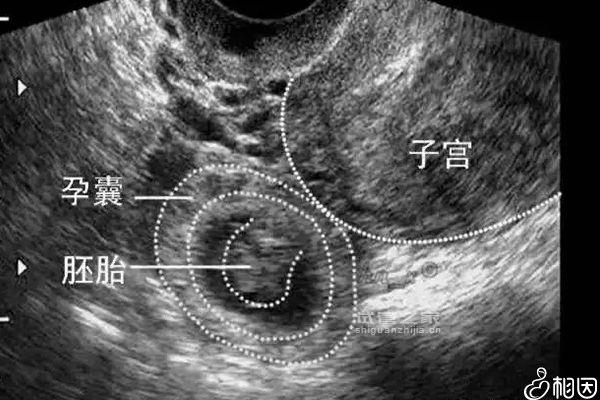 試管嬰兒懷孕4個月了還出血不正常！該怎么辦專家來支招