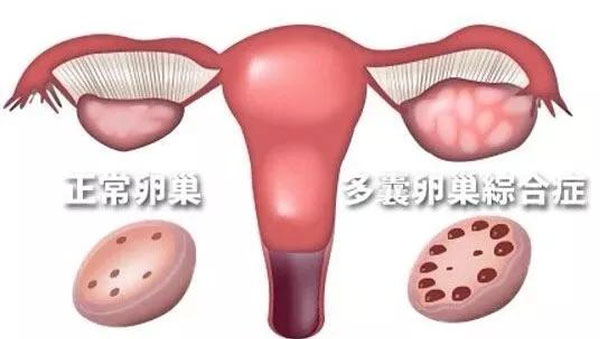 多囊*巢能懷孕嗎?5小技巧可以幫助提高受孕率