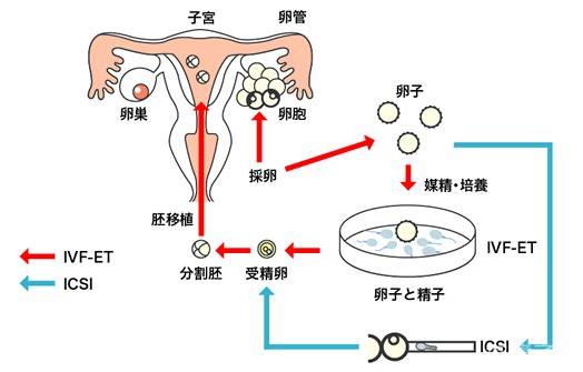 試管嬰兒的新興方式和輔助生殖技術(shù)