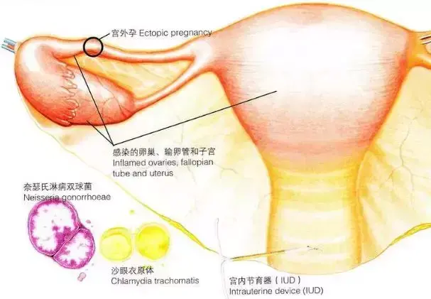 宮外孕雙胞胎會(huì)怎么樣？宮外孕雙胞胎怎么辦？