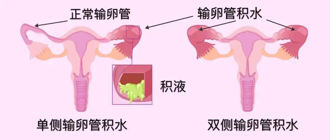 輸*管通不通，造影還是通水宮腔鏡？