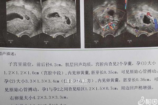 別糾結(jié)試管二超是陰超還是腹超了，先看會不會導致流產(chǎn)再說 ...