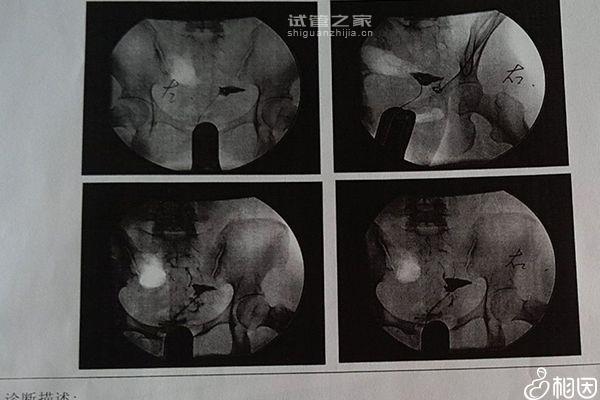 8細(xì)胞二級胚胎著床率因人而異，不著床或和激素異常有關(guān)