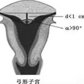 子宮畸形對妊娠有什么影響？