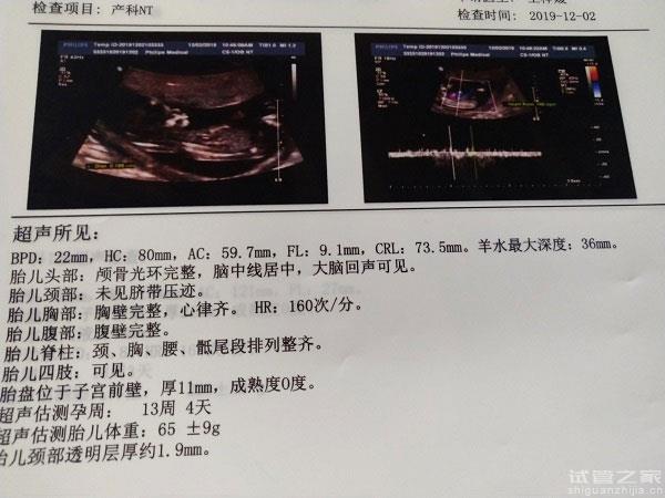 為什么醫(yī)生建議不用做NT檢查？孕周不足、胎位不正是主因