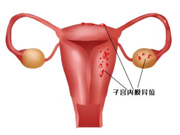 子宮內(nèi)膜異位癥為何會導(dǎo)致不孕？