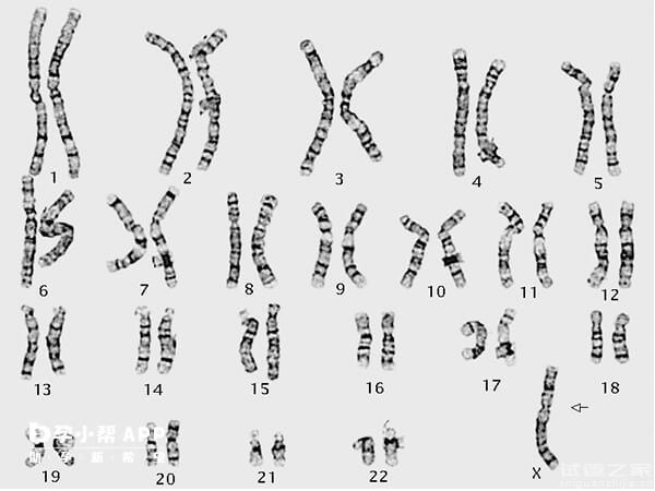 揭秘21號染色體隨體柄增長臨床意義，要想生子必須做試管