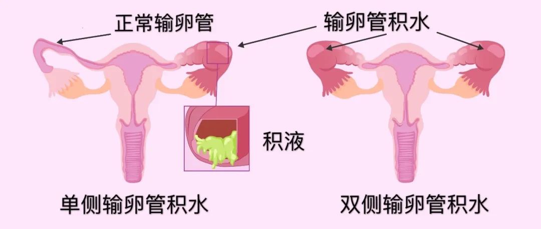 試管嬰兒助孕中出現(xiàn)宮腔積液咋辦？試管嬰兒助孕中出現(xiàn)宮腔積液是有哪些原因造成的呢？ ...