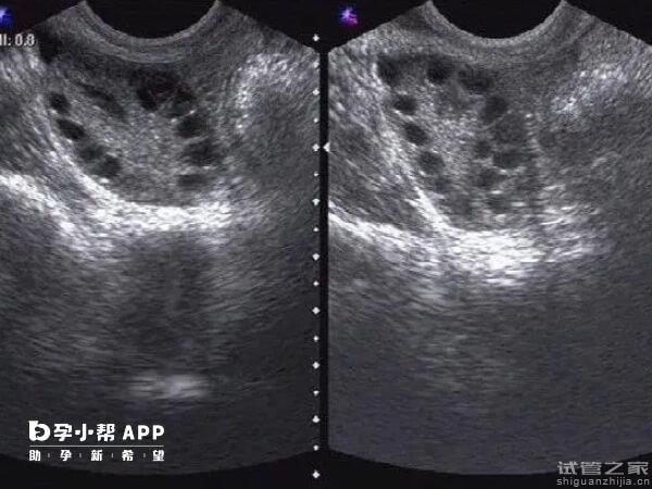 怎樣拍打小腹讓*泡盡快破裂？學(xué)會這幾種方法輕松搞定