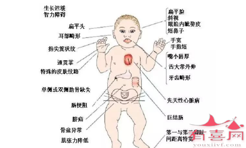 雙方染色體異常可以做試管嗎