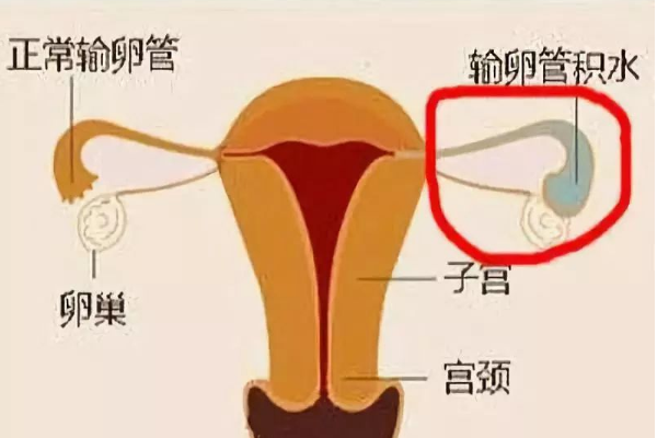 輸*管積水手術(shù)后懷孕幾率多大？主要看這些方面的影響有多大 ...