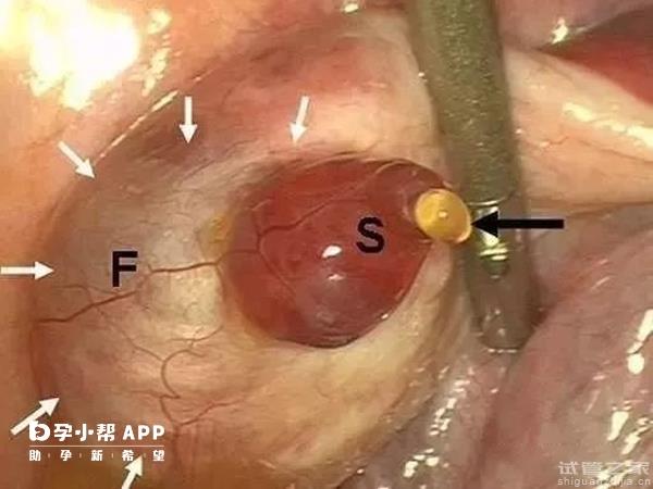 *泡排出來的樣貌圖解，出現(xiàn)這4種癥狀說明已排*！