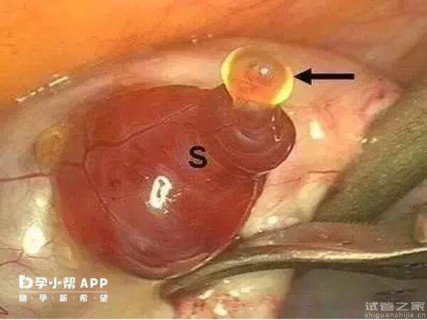 *泡排出來的樣貌圖解，出現(xiàn)這4種癥狀說明已排*！