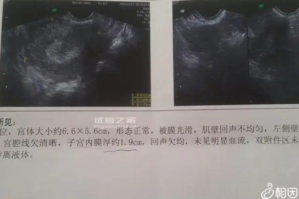 別還不造內膜10mm鮮胚容不容易著床，能否移植看這幾點