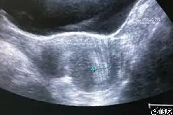 內(nèi)膜17mm懷孕幾率不高別慌，想知道怎么辦先弄清原因