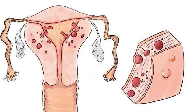 子宮腺肌癥可以做手術治療嗎？能試管生孩子嗎？