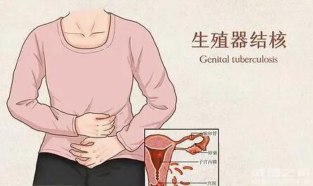 盆腔結(jié)核還能正常懷孕嗎？能不能做試管？