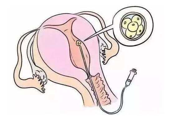 宮腔粘連試管成功率多大費用多少？