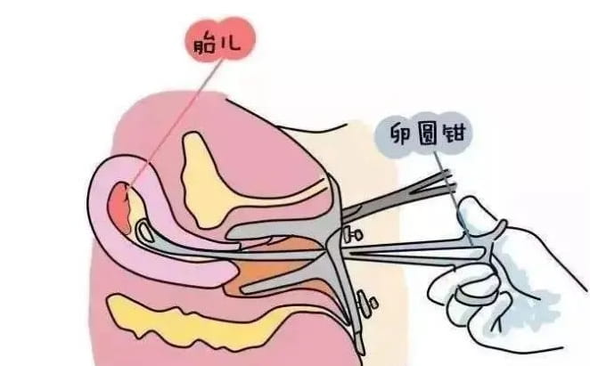 試管移植前為什么要進行子宮內(nèi)膜診刮？做試管嬰兒的都要刮宮嗎？試管嬰兒前期的準備工 ...