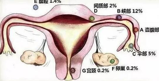 宮外孕患者做試管效果好嗎一共多少錢？