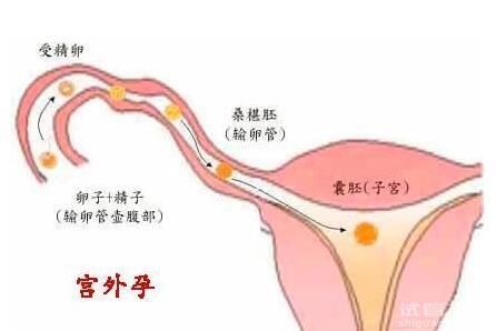 宮外孕后做試管還容易宮外孕嗎？試管費用多少錢？