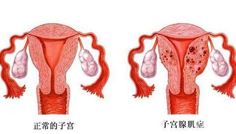 2024子宮腺肌癥可以做試管嗎多少錢？