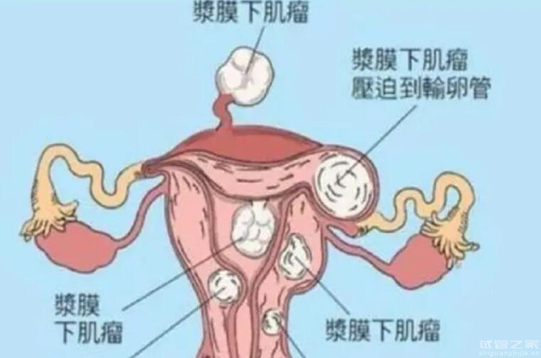 殘角子宮能治愈嗎做試管能成功嗎？