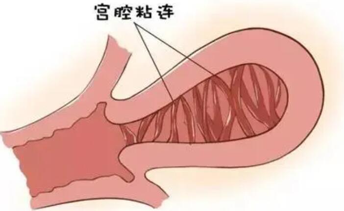 宮腔粘連試管移植后能著床嗎多少錢？