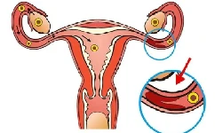 卵巢囊腫是子宮囊腫嗎：卵巢囊腫是不是子宮囊腫?