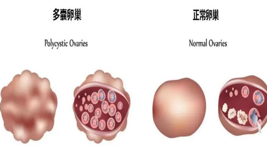 多囊卵巢做試管男孩的成功率有多大啊？