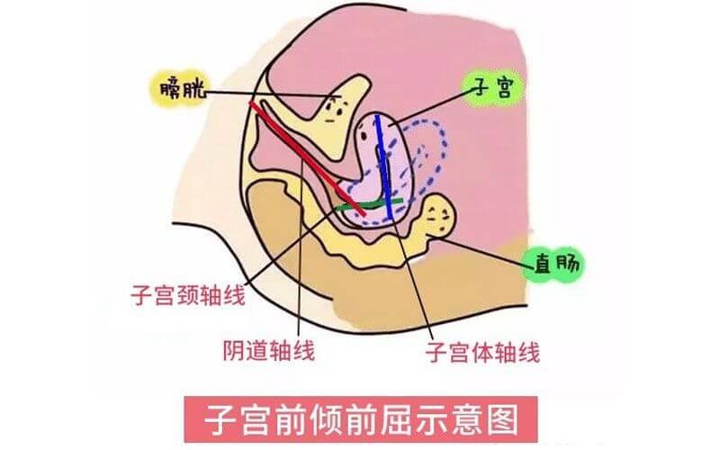 子宮前位形成原因揭秘，孕前、孕中引起因素有不同