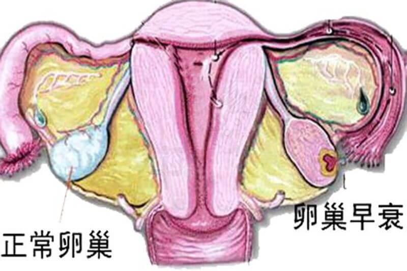 卵巢早衰有哪些表現(xiàn)？3個治療方法可挽回青春活力