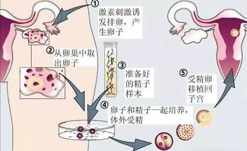 女性子宮內(nèi)膜異位癥試管成功率高嗎？女性患有子宮內(nèi)膜異位癥做試管會(huì)成功嗎? 