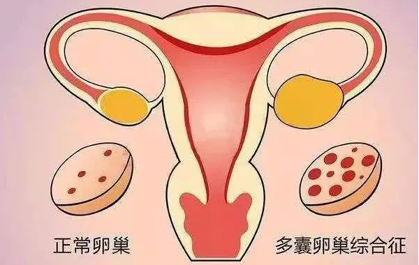 多囊試管促排卵針用進口還是國產(chǎn)都一樣?