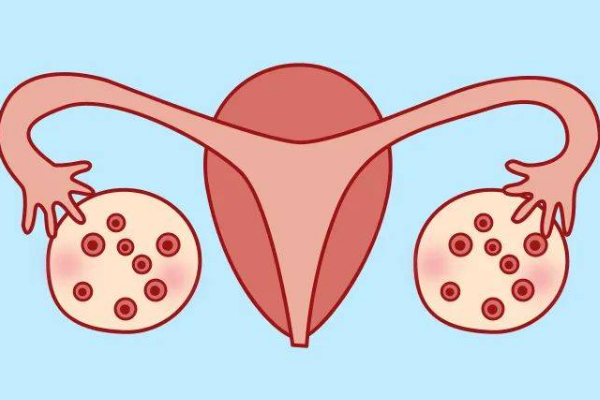 多囊女性?xún)纱卧嚬艹晒Π咐窒?，調(diào)理好身體非常重要