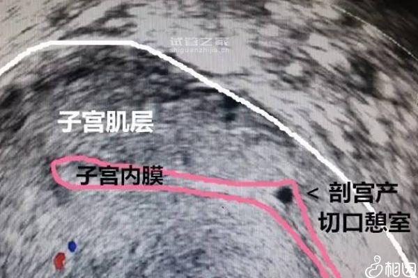 子宮憩室試管移植不著床解決方法來咯，弄清原因輕松解決