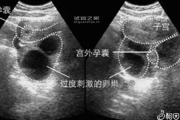 不懂凍胚移植30天為啥會出血進，是不是著床了一篇講清