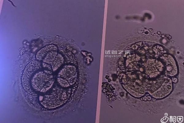 移植單胎變雙胎的過程分享，具體流程、注意什么要早知