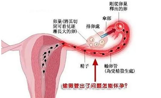 輸卵管粘連不容忽視，不孕不育大部分是它的原因！河北哪家醫(yī)院擅長(zhǎng)輸卵管粘連的試管方 ...