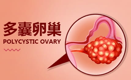 什么是多囊卵巢綜合征(PCOS)？多囊卵巢綜合癥可以做試管嗎？多囊卵巢綜合征診斷標(biāo)準(zhǔn)- ...