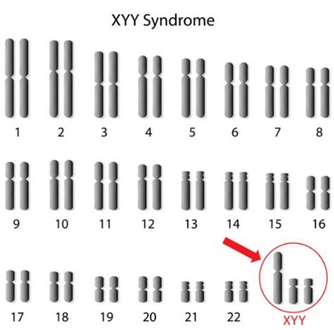 染色體異?？梢陨稣５男『幔咳嚬艹蔀槭走x