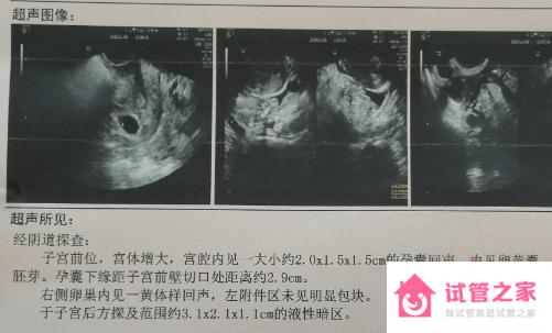 b超如何看是女兒還是兒子