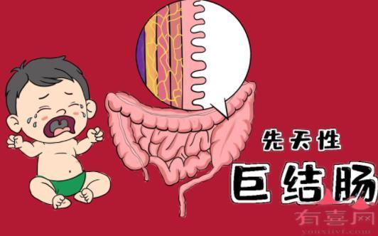 先天性巨結(jié)腸患兒的癥狀