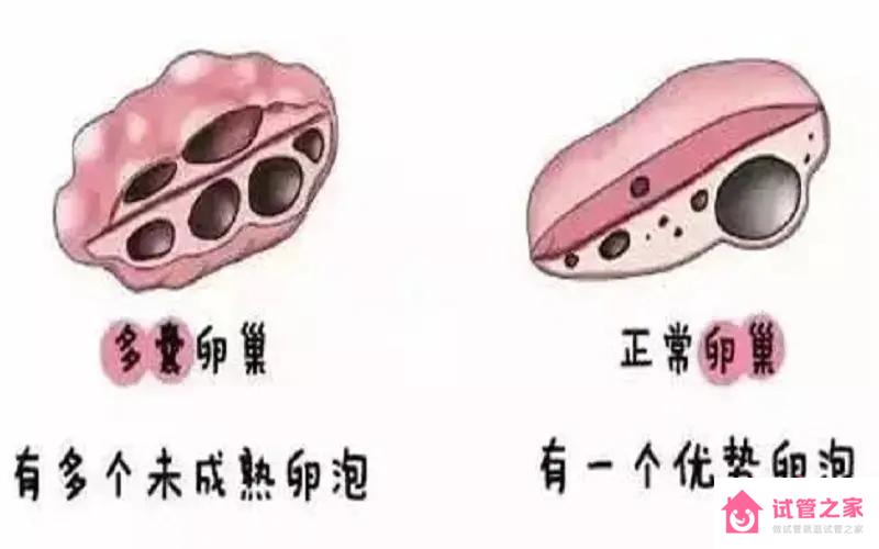 多囊*巢綜合癥