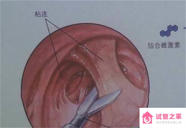 重度宮腔粘連疾病患者在手術(shù)后多久可以懷孕？