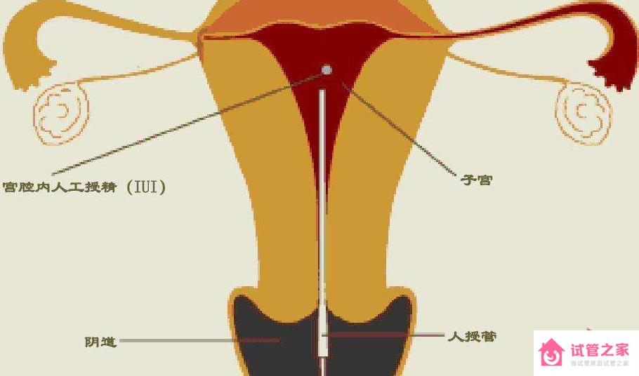 人工授精的成功率有多少