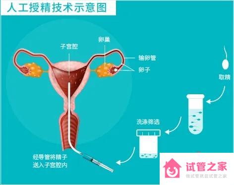 女方做人工授精的過(guò)程是怎樣的