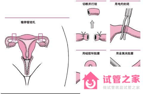 單側(cè)輸*管切除還會(huì)有宮外孕嗎