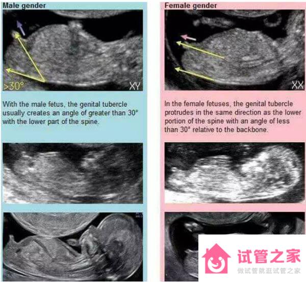 孕12周nt暗示男女方法揭秘，數(shù)值大小、nub點(diǎn)可區(qū)分