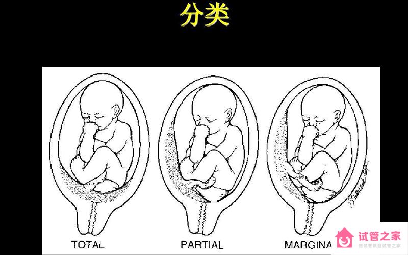 前置胎盤和后置胎盤區(qū)別不止是顯懷，能否順產也有差